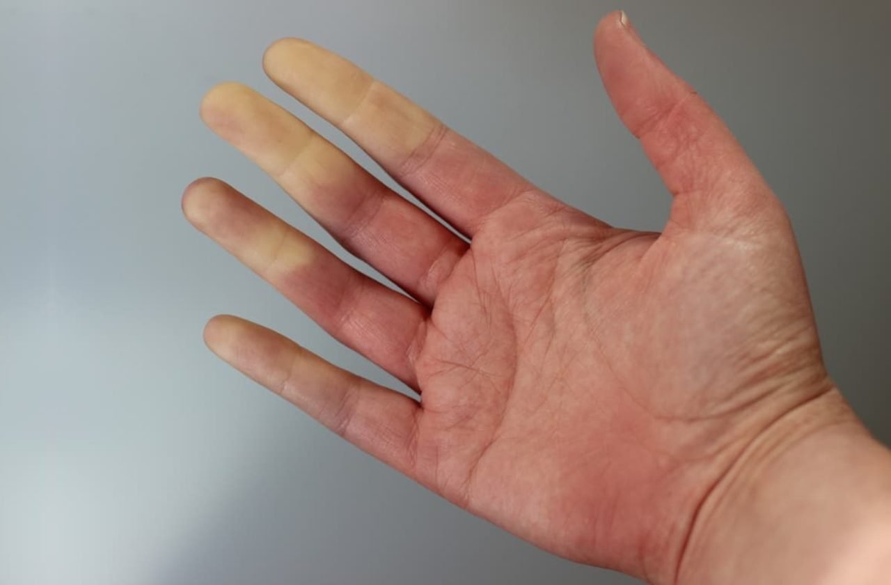 Σύνδρομο ρεϊνό Raynaud