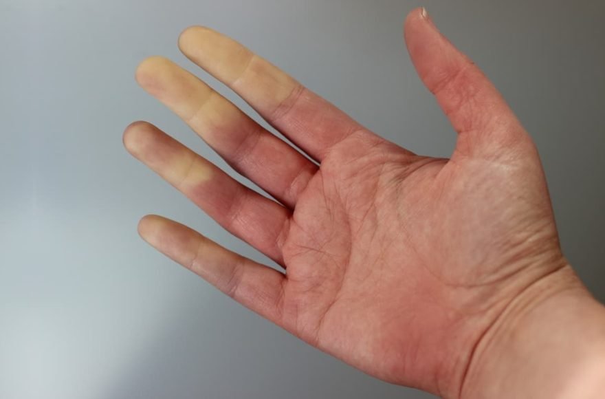 Σύνδρομο ρεϊνό Raynaud